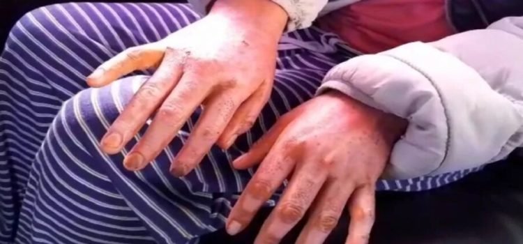 Víctimas de explosión por acumulación de gas en Toluca solicitan ayuda para atender quemaduras