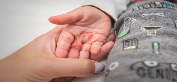 Virus Coxsackie es común en escuelas de Toluca de acuerdo con el IMSS