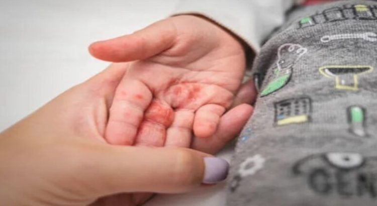 Virus Coxsackie es común en escuelas de Toluca de acuerdo con el IMSS