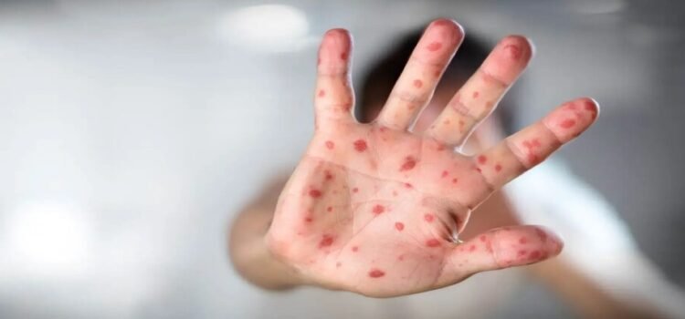 Confirman 4 casos de sarampión en Edomex Confirman 4 casos de sarampión en Edomex