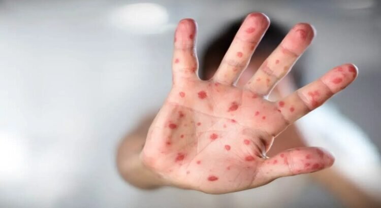 Confirman 4 casos de sarampión en Edomex Confirman 4 casos de sarampión en Edomex