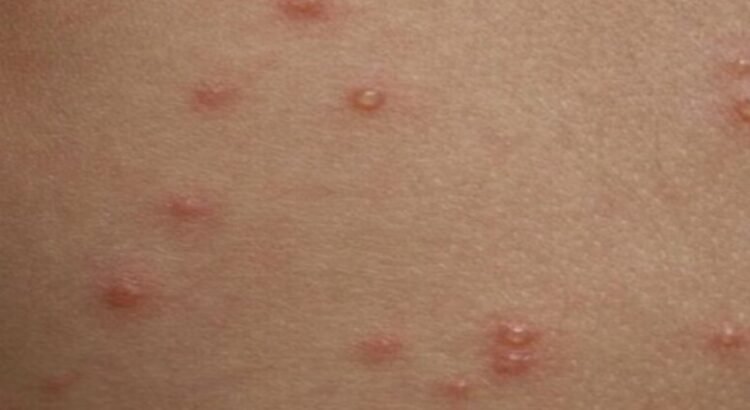 Casos de varicela en Edomex reportados durante noviembre